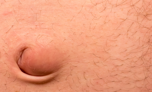 hérnia umbilical