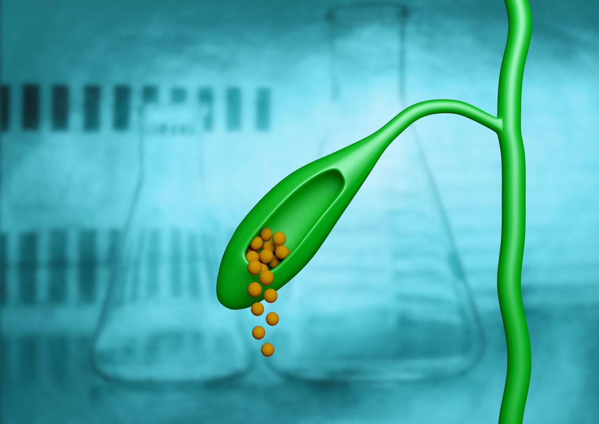 cálculo na vesícula